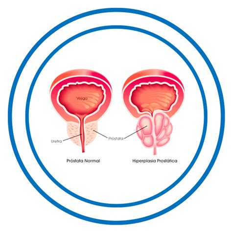 Patología prostática weburologia en Benidorm Alicante España