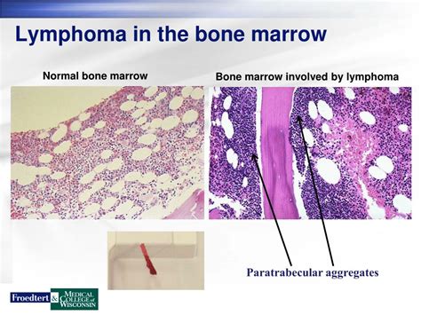 Ppt Lymphoma Overview Powerpoint Presentation Free Download Id4501266