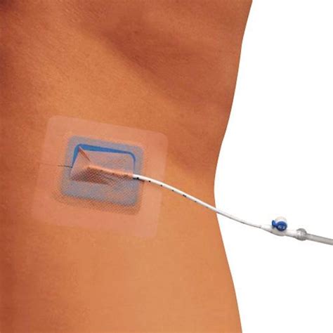 SKATER Fix Catheter Fixation Device Argon Medical 49 OFF