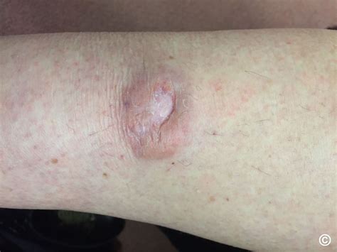 Systemic Amyloidosis With Cutaneous Manifestations, 42% OFF