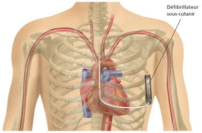 Défibrillateur cardiaque implantable Lyon CCJJ Centre