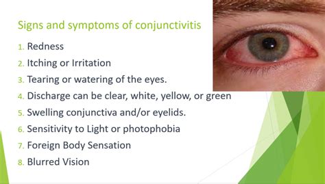 Conjuntivitis Signs Symptoms And Treatment Ms Thu Medical English