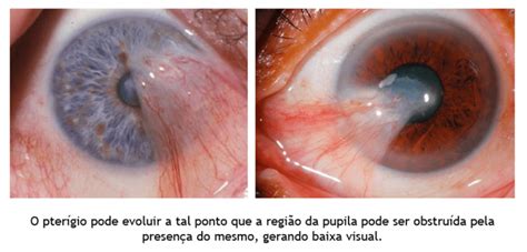 Cirurgia De Pter Gio Von Hertwig Cl Nica E Hospital De Olhos