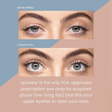 Upneeq Lifting Eye Drops Binhlam Aesthetics Nashville Tn