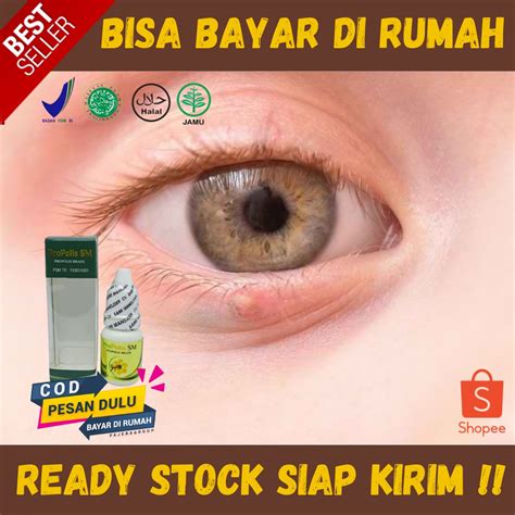 Jual Obat Oles Penghilang Benjolan Di Kelopak Mata Salep Pengempis