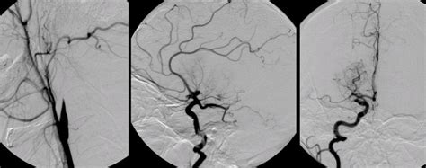 Carotid Artery Dissection 4