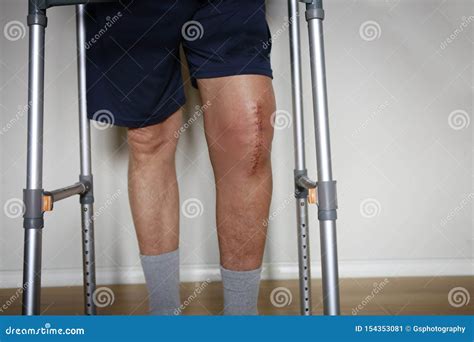 Painful Scar after Knee Surgery Stock Image - Image of skin, scar: 154353081