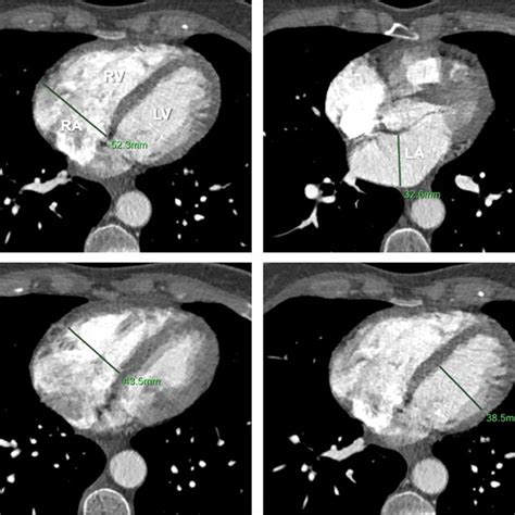 Example Of Manual Diameter Measurements Of Cardiac Chambers On Standard Download Scientific