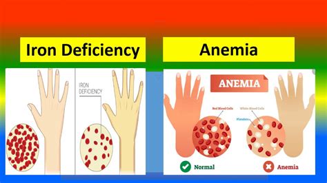 Difference Between Iron Deficiency And Anemia YouTube