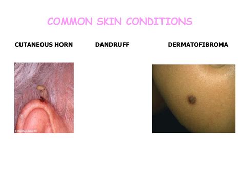 PPT - COMMON SKIN CONDITIONS PowerPoint Presentation, free download ...