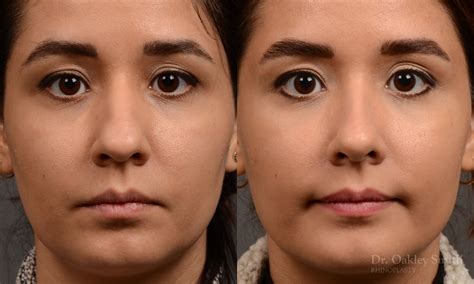 Rhinoplasty Before And After Case 456 Toronto Rhinoplasty Surgery