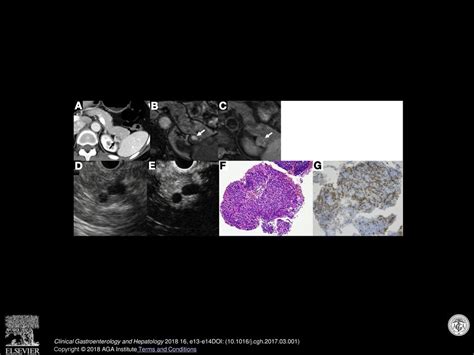 Epidermoid Cyst In An Intrapancreatic Accessory Spleen Diagnosed By Typical Radiographic Images