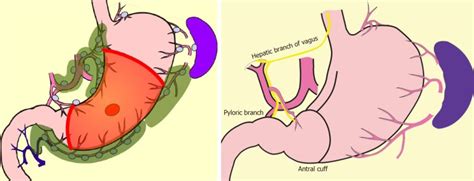 Precision Surgical Approach With Lymph Node Dissection In Early Gastric