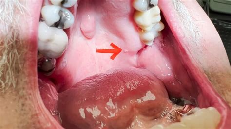 Hpv Bumps In Throat