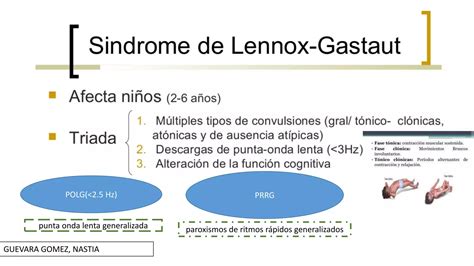 Sindrome De West Y Sindrome De Lennox Gastaud PPT