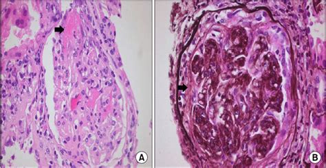 A An Interlobular Artery Shows Fibrinoid Necrosis Arrow With Download Scientific Diagram