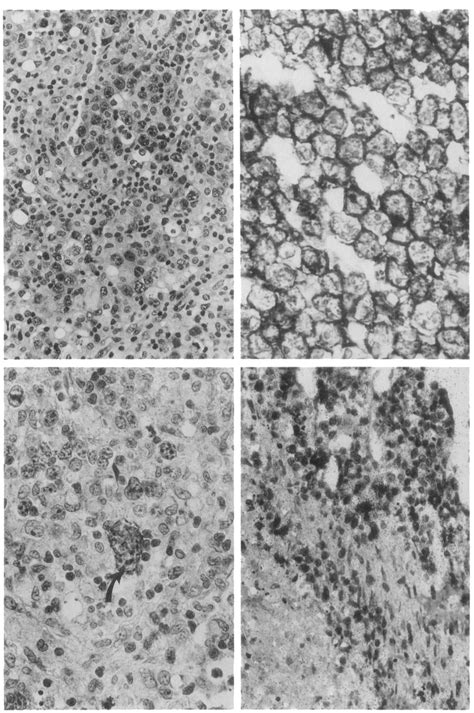 Upper Left Lymphoma With Characteristic Anaplastic Large Cells