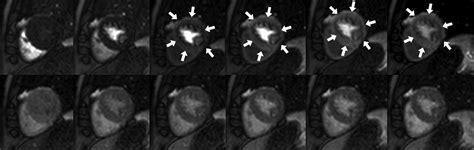 Comparison Of Stress Perfusion Mri And Spect For Detection Of