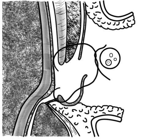 History of the Inguinal Hernia Repair | IntechOpen