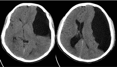 Arachnoid Cyst As A Rare Cause Of Headache In A Teenager Case Report Ak Journal Of