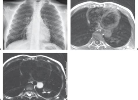 Mediastinum The Mediastinum Radiology Key