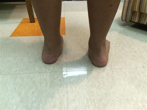 Arthroereisis - Foot and Ankle Clinics