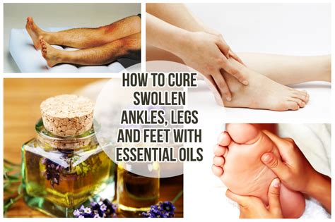 Home Remedies For Swollen Feet