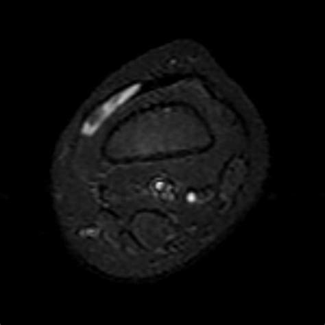 Intramuscular Cysticercosis Image Radiopaedia Org