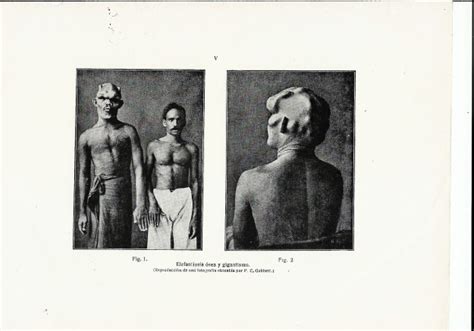 elefantiasis osea  gigantismo blog de tomas cabacas