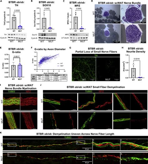 Schwann Cells Contribute To Demyelinating Diabetic Neuropathy And Nerve