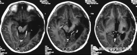 【典型病例】儿童低级别胶质瘤复发进展后的有效治疗1例基底节区胶质瘤mri病例儿童复发治疗核磁肿瘤化疗患儿复查占位 健康界