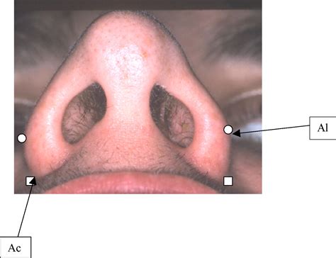 Efficacy And Stability Of The Alar Base Cinch Suture British Journal