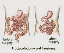 Medical Treatment Pictures-for Better Understanding: Proctocolectomy ...