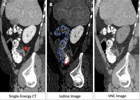 Radiology On Twitter In A 43 Year Old Man With Acute Uncomplicated