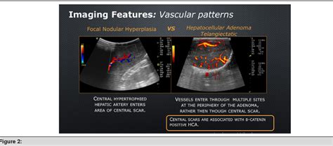 Pdf Hepatic Adenomas Challenges To Their Diagnosis And Management With Emphasis On The