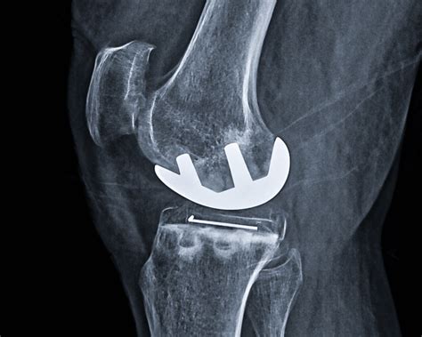 Partial Knee Replacement Adam Sassoon Md Ms