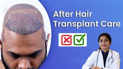 How To Take Care After Hair Transplant Surgery Youtube