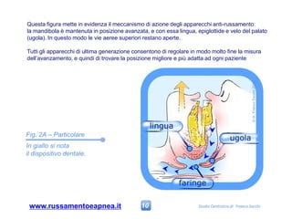 Cura Del Russamento E Delle Apnee Con Apparecchi Dentali PPT