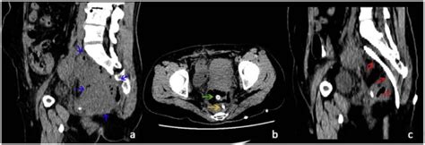 CT Guided Drainage Of Deep Pelvic Abscesses Via A Percutaneous