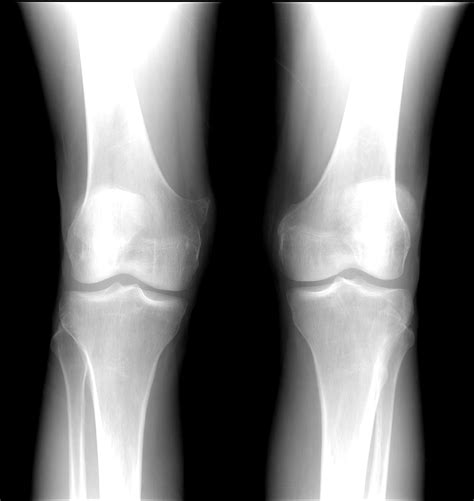 Osteochondroma Image Radiopaedia Org