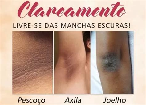 Clareador Virilha Cido Retinoico Peeling D Tca Brinde Venda Em