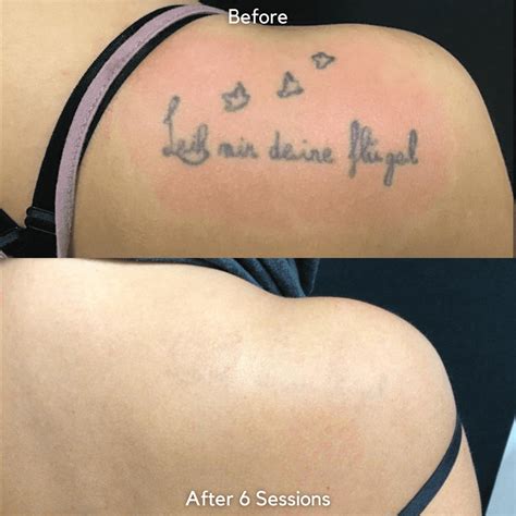 List Pictures Before And After Photos Of Tattoo Removal Full Hd