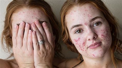 How To Stay Confident With Acne And Acne Scars Youtube