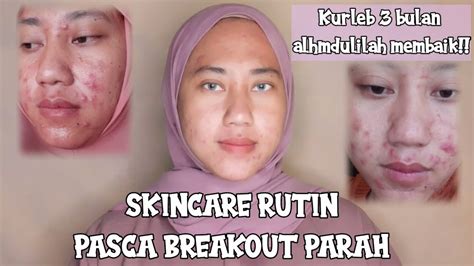 Skincare Rutin Pasca Breakout Parah Jerawat Batu Semuka Youtube