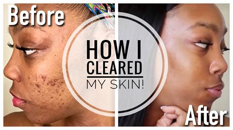 How I Cleared My Skin My Accutane Journey Side Effects And Tips