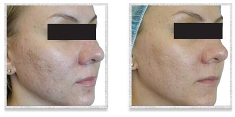 Fractional Radiofrequency Skin Resurfacing Viva Martha E Stewart