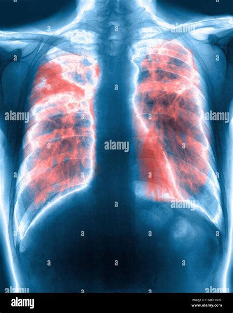 Lung Fibrosis Coloured X Ray Of The Chest Of A Patient With Pulmonary