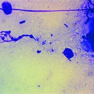 Neutrophil extracellular traps in the tumor center of a patient with ...