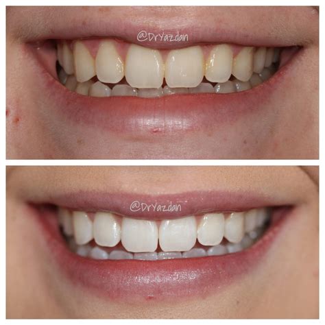 Four Times To Consider Teeth Whitening Center For Restorative