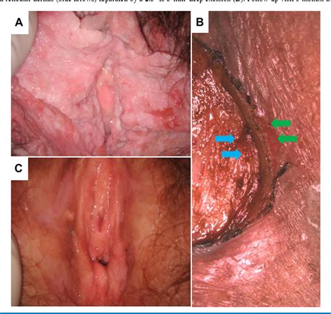 Figure 1 From Instruments And Techniques Co 2 Laser Total Superficial Vulvectomy An Outpatient